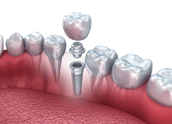 Implantology